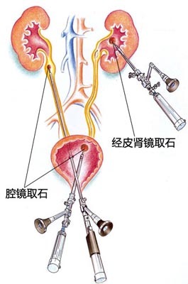 肾结石微创手术